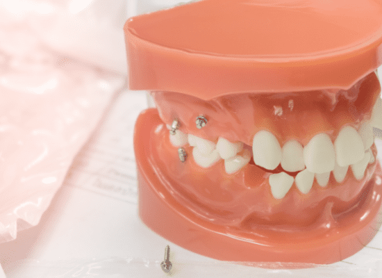 歯科矯正用アンカースクリューのメリット