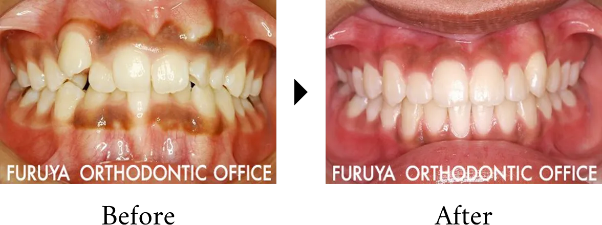 子どもの埋伏歯・先天性欠損歯